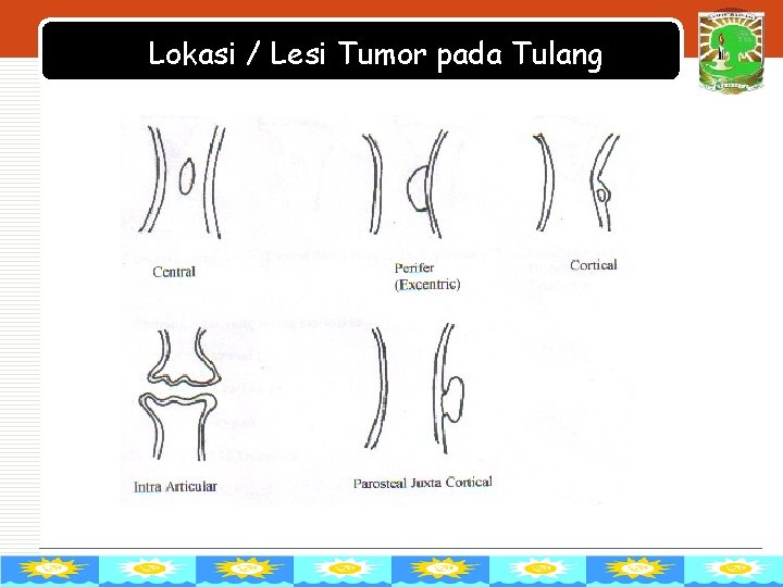 Lokasi / Lesi Tumor pada Tulang LOGO 