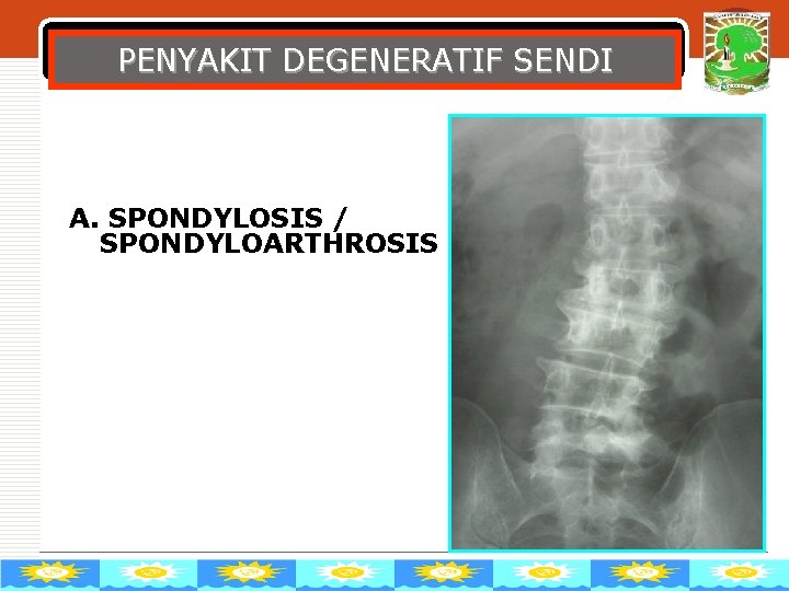 PENYAKIT DEGENERATIF SENDI A. SPONDYLOSIS / SPONDYLOARTHROSIS LOGO 