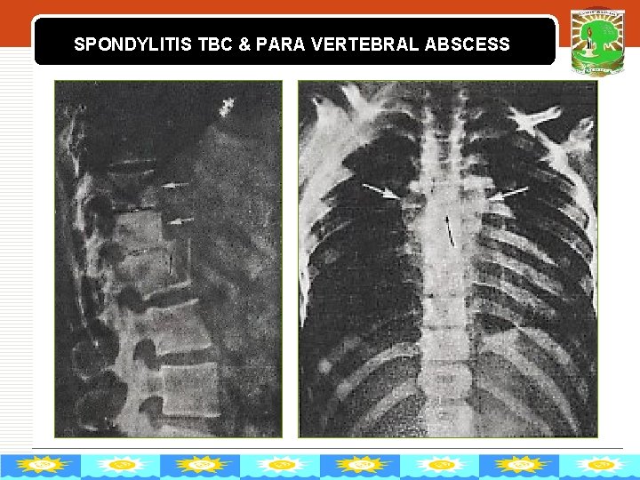 SPONDYLITIS TBC & PARA VERTEBRAL ABSCESS LOGO 