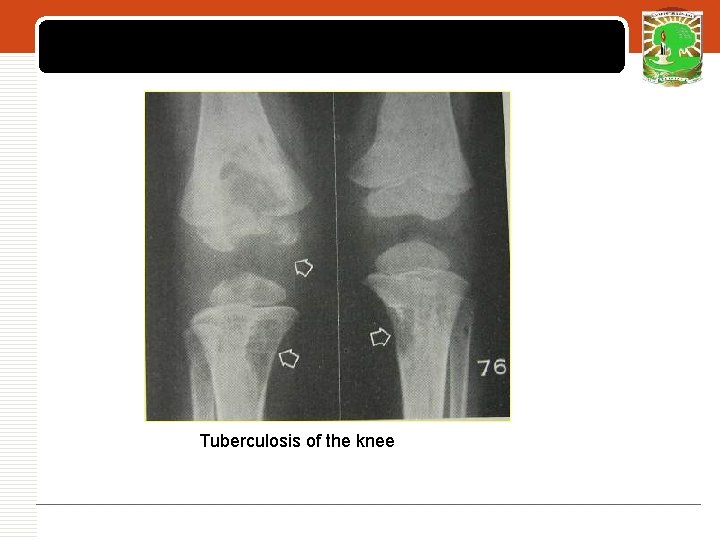 LOGO Tuberculosis of the knee 