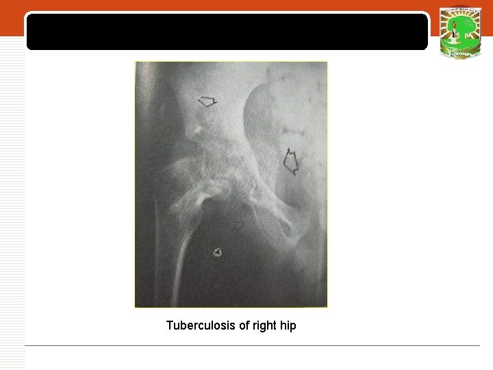 LOGO Tuberculosis of right hip 