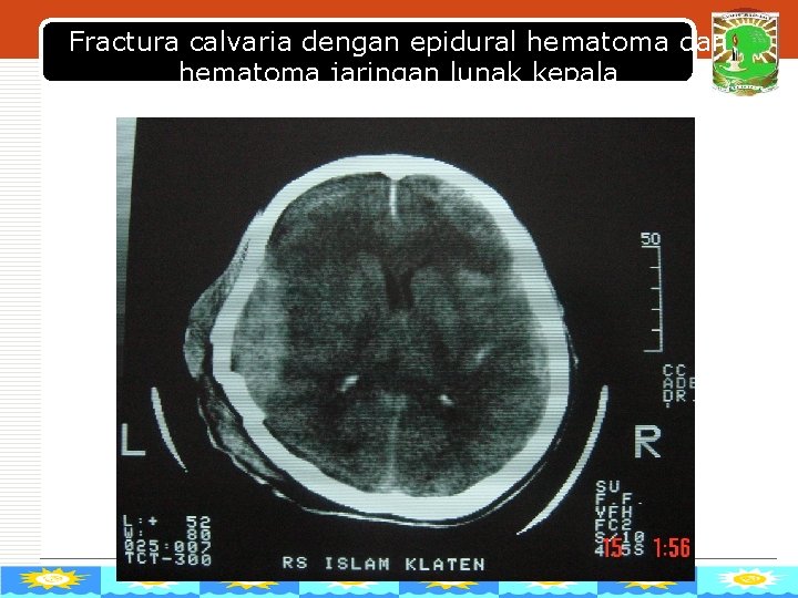 Fractura calvaria dengan epidural hematoma dan. LOGO hematoma jaringan lunak kepala 