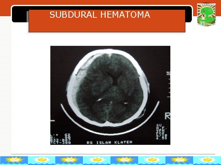 SUBDURAL HEMATOMA LOGO 