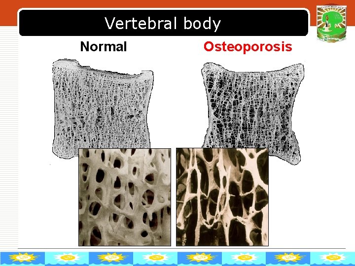 Vertebral body Normal Osteoporosis LOGO 