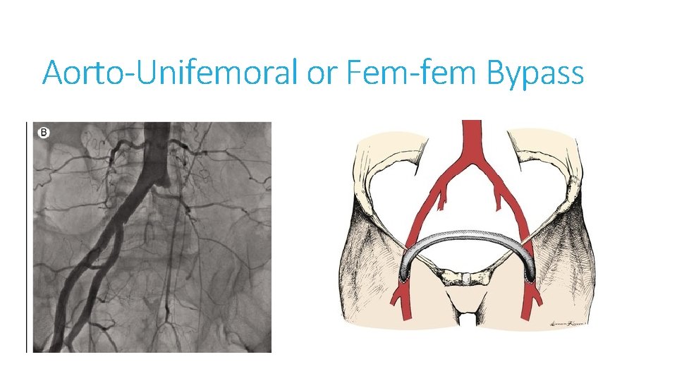 Aorto-Unifemoral or Fem-fem Bypass 