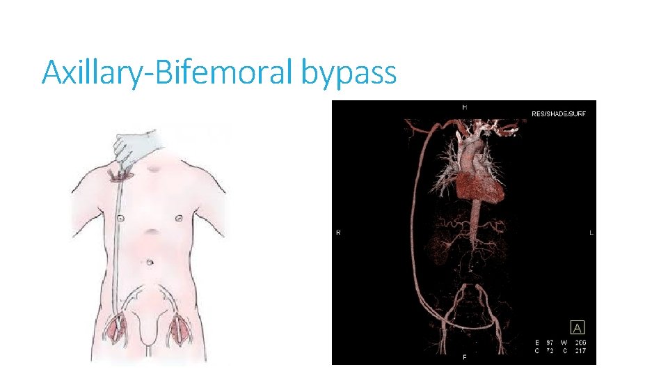 Axillary-Bifemoral bypass 