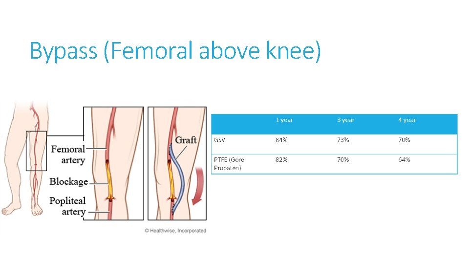 Bypass (Femoral above knee) 