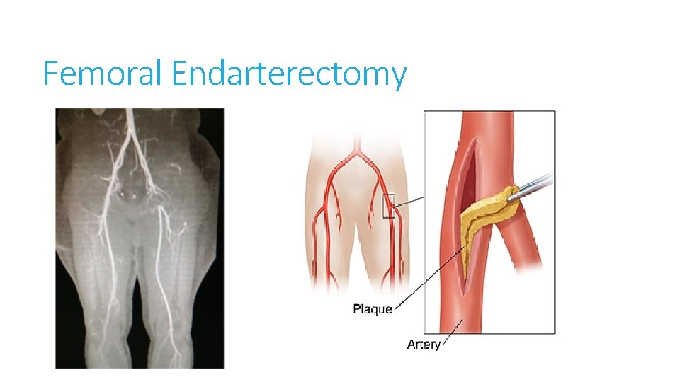 Femoral Endarterectomy 