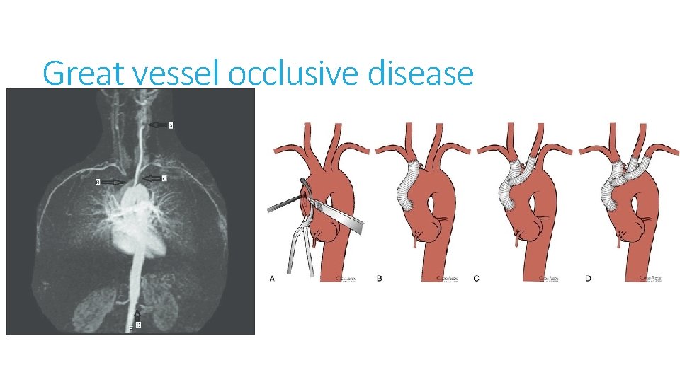 Great vessel occlusive disease 