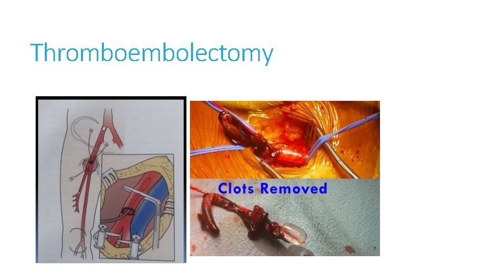 Thromboembolectomy 