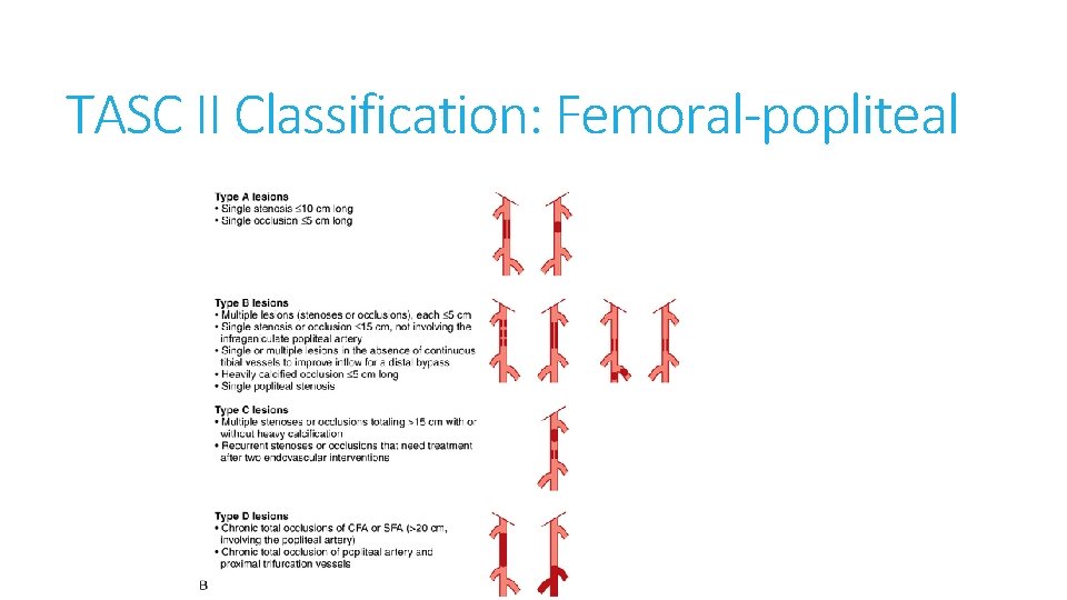 TASC II Classification: Femoral-popliteal 