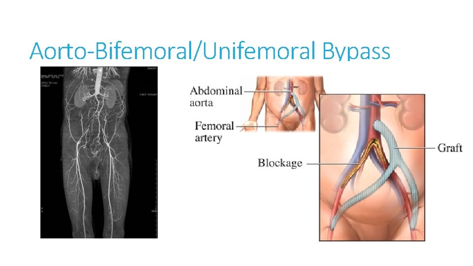 Aorto-Bifemoral/Unifemoral Bypass 