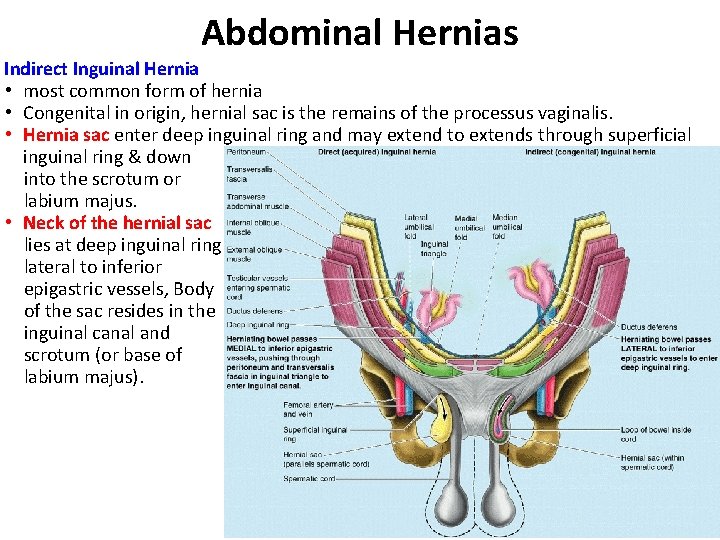Abdominal Hernias Indirect Inguinal Hernia • most common form of hernia • Congenital in
