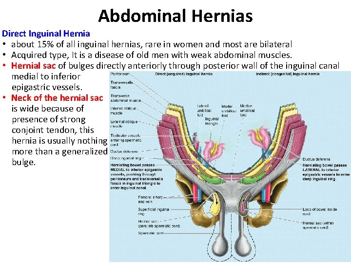 Abdominal Hernias Direct Inguinal Hernia • about 15% of all inguinal hernias, rare in