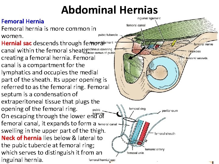 Abdominal Hernias Femoral Hernia Femoral hernia is more common in women. Hernial sac descends