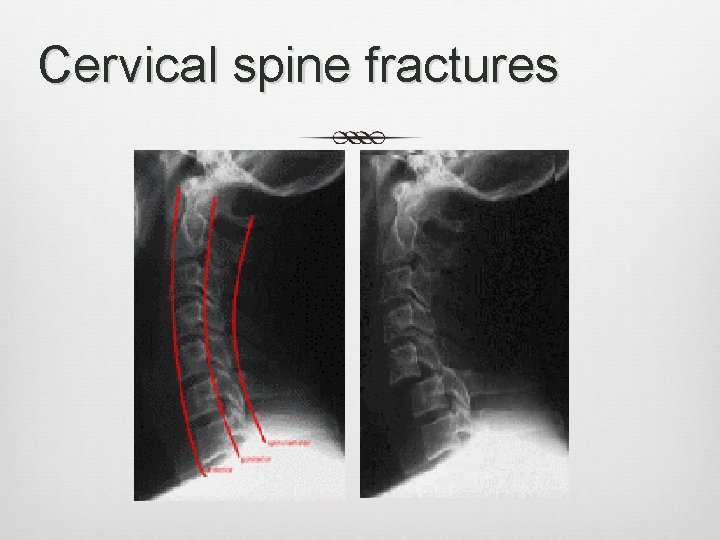 Cervical spine fractures 