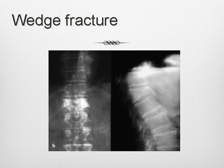 Wedge fracture 