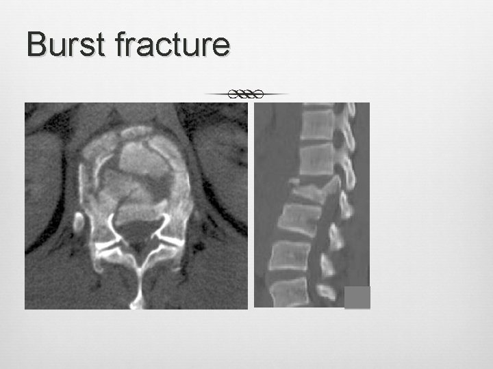 Burst fracture 