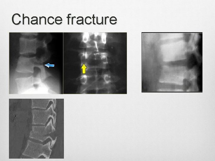 Chance fracture 