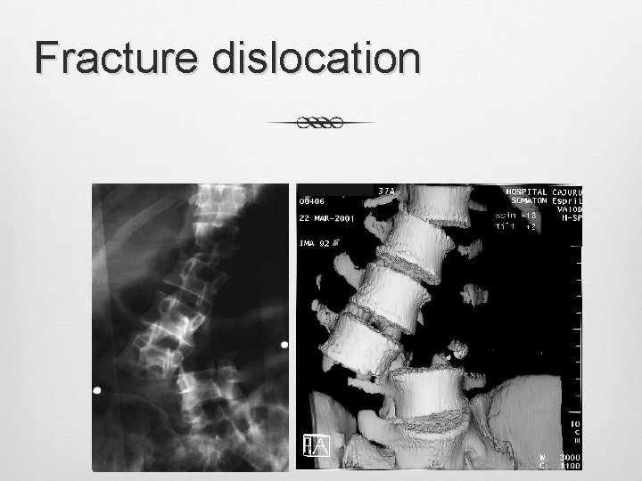 Fracture dislocation 