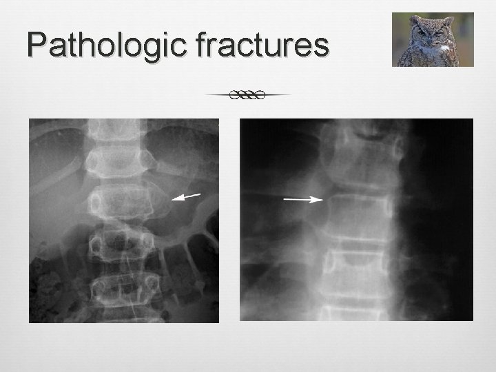 Pathologic fractures 