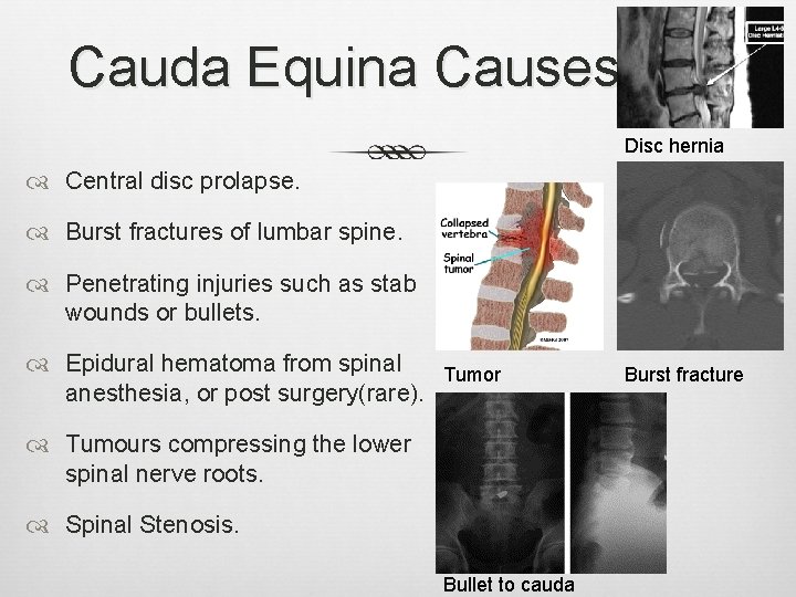 Cauda Equina Causes Disc hernia Central disc prolapse. Burst fractures of lumbar spine. Penetrating