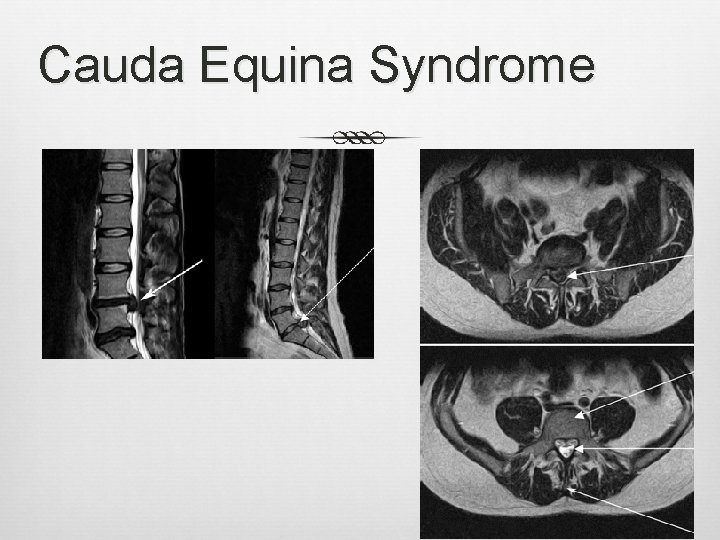 Cauda Equina Syndrome 