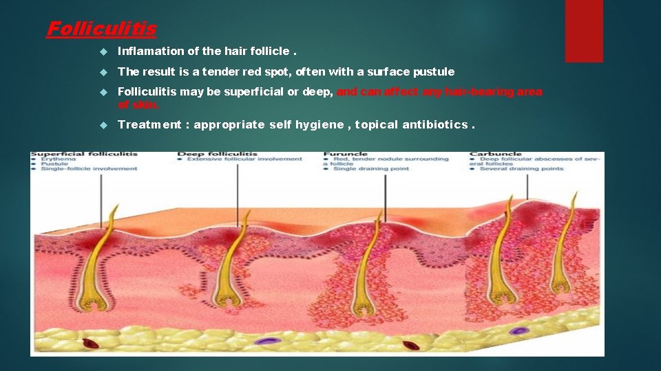 Folliculitis Inflamation of the hair follicle. The result is a tender red spot, often