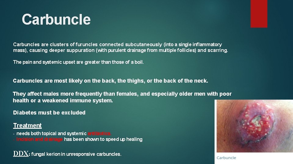Carbuncles are clusters of furuncles connected subcutaneously (into a single inflammatory mass), causing deeper
