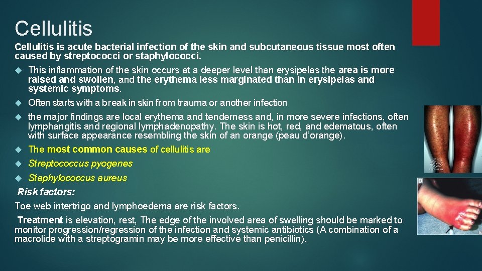 Cellulitis is acute bacterial infection of the skin and subcutaneous tissue most often caused