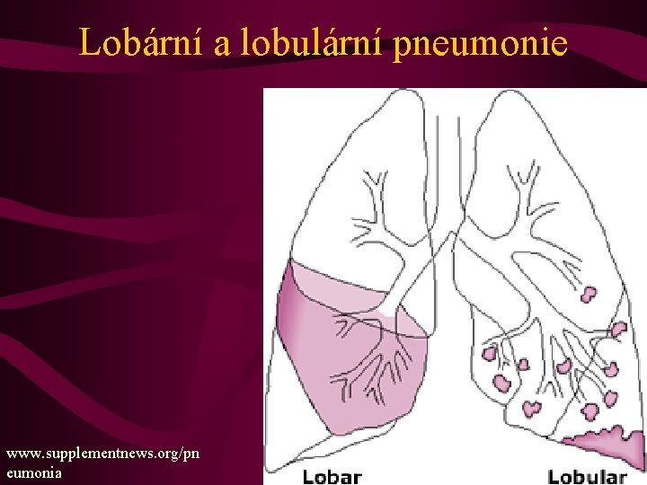 Lobární a lobulární pneumonie www. supplementnews. org/pn eumonia 