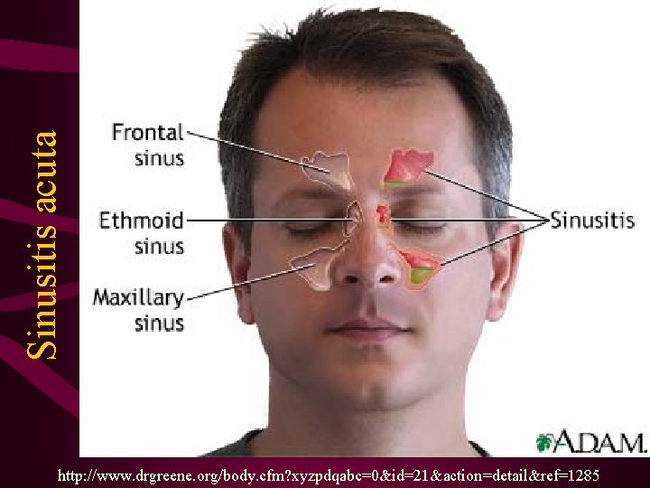 Sinusitis acuta http: //www. drgreene. org/body. cfm? xyzpdqabc=0&id=21&action=detail&ref=1285 