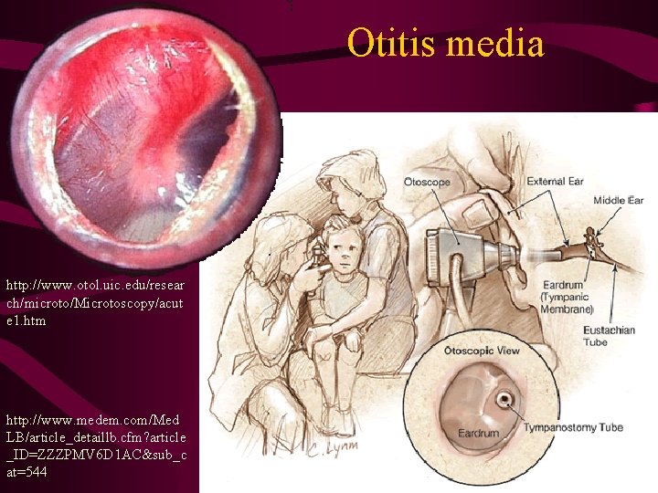 Otitis media http: //www. otol. uic. edu/resear ch/microto/Microtoscopy/acut e 1. htm http: //www. medem.