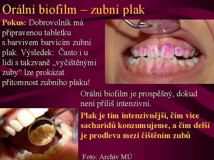 Orální biofilm – zubní plak Pokus: Dobrovolník má připravenou tabletku s. barvivem barvícím zubní