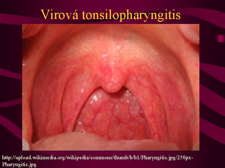 Virová tonsilopharyngitis http: //upload. wikimedia. org/wikipedia/commons/thumb/b/b 1/Pharyngitis. jpg/250 px. Pharyngitis. jpg 