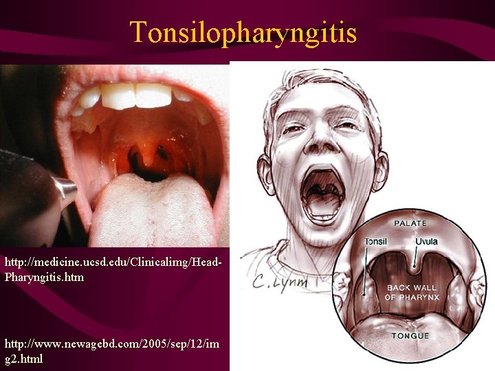 Tonsilopharyngitis http: //medicine. ucsd. edu/Clinicalimg/Head. Pharyngitis. htm http: //www. newagebd. com/2005/sep/12/im g 2. html