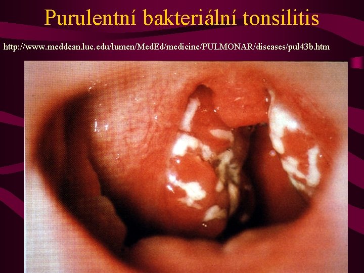 Purulentní bakteriální tonsilitis http: //www. meddean. luc. edu/lumen/Med. Ed/medicine/PULMONAR/diseases/pul 43 b. htm 