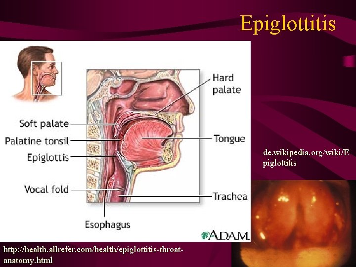 Epiglottitis de. wikipedia. org/wiki/E piglottitis http: //health. allrefer. com/health/epiglottitis-throatanatomy. html 