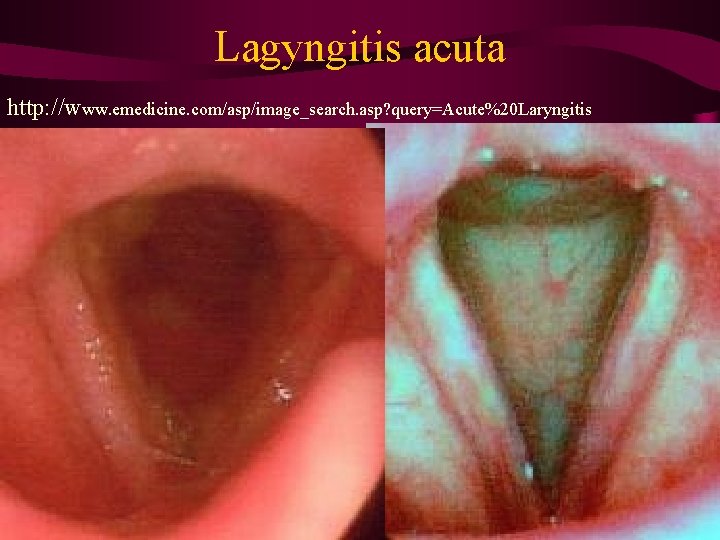 Lagyngitis acuta http: //www. emedicine. com/asp/image_search. asp? query=Acute%20 Laryngitis 