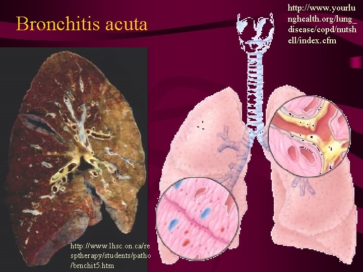 Bronchitis acuta http: //www. lhsc. on. ca/re sptherapy/students/patho /brnchit 5. htm http: //www. yourlu