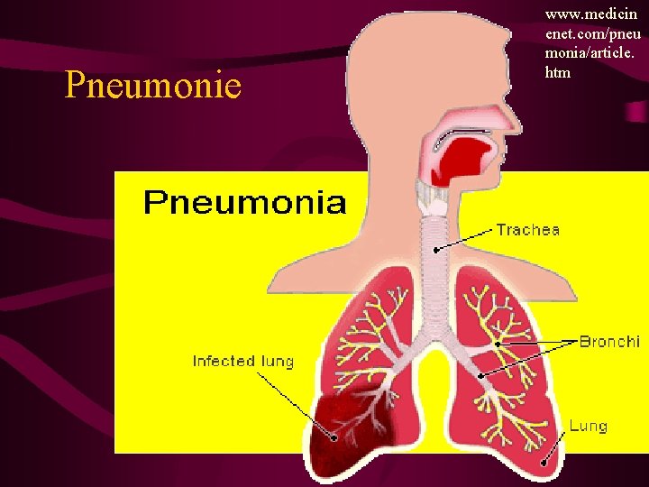 Pneumonie www. medicin enet. com/pneu monia/article. htm 