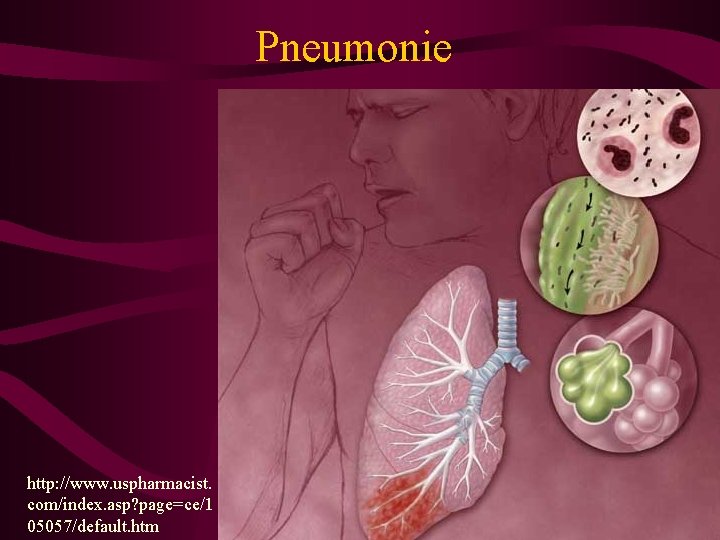 Pneumonie http: //www. uspharmacist. com/index. asp? page=ce/1 05057/default. htm 