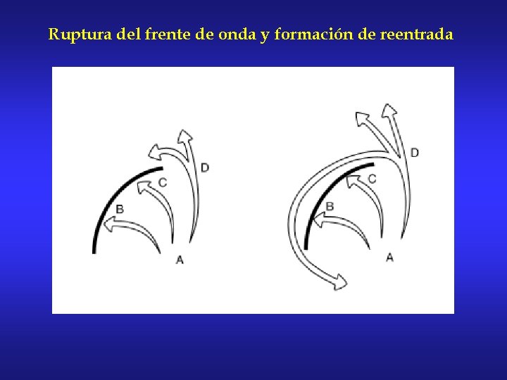 Ruptura del frente de onda y formación de reentrada 