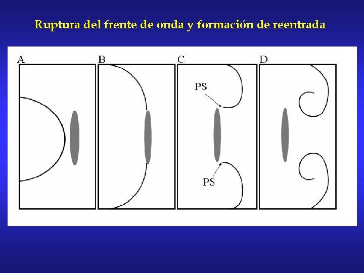 Ruptura del frente de onda y formación de reentrada 