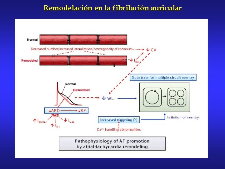 Remodelación en la fibrilación auricular 