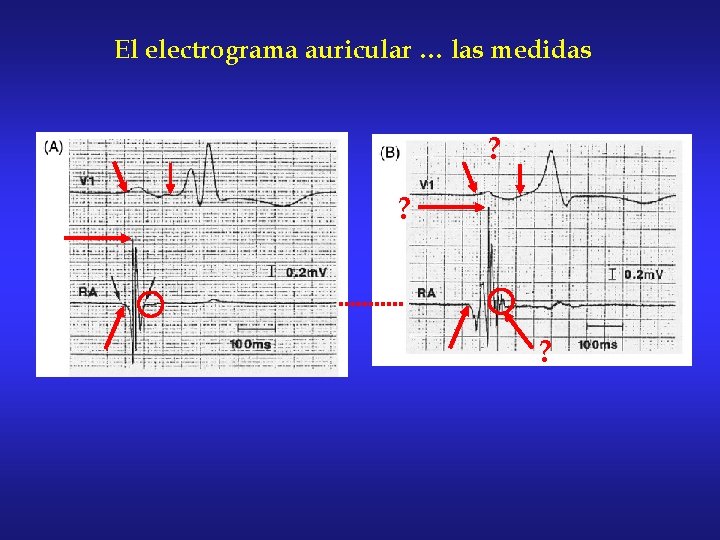 El electrograma auricular … las medidas ? ? ? 