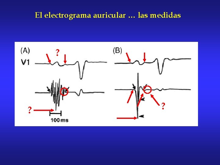 El electrograma auricular … las medidas ? ? ? 