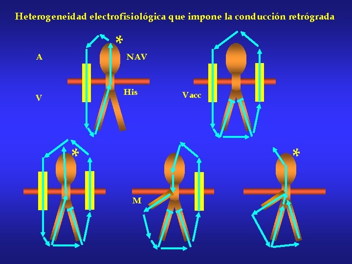 Heterogeneidad electrofisiológica que impone la conducción retrógrada * NAV A His V * Vacc