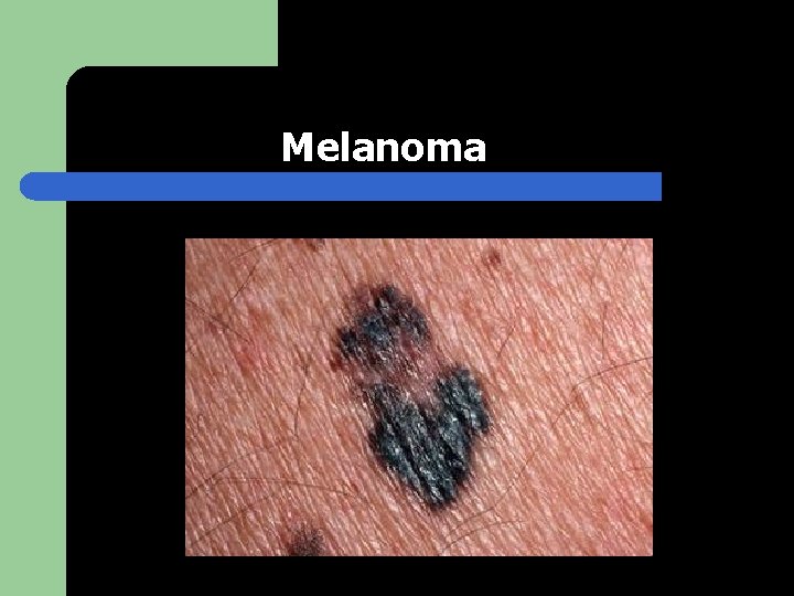 Melanoma 