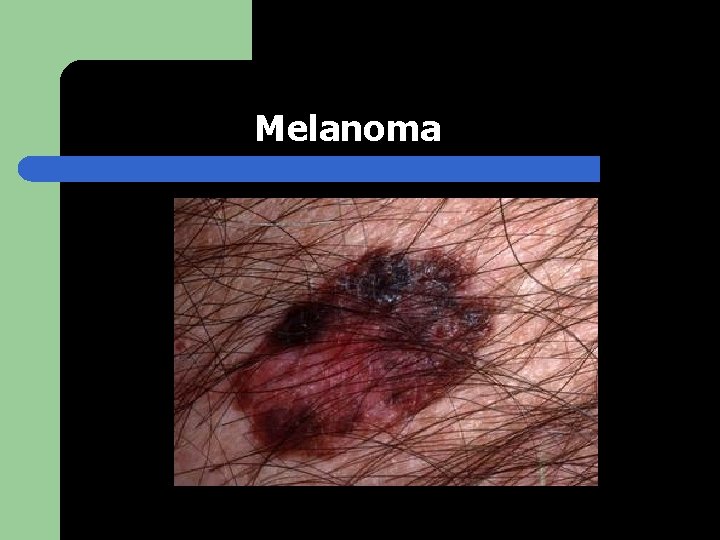 Melanoma 